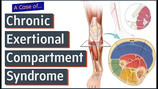 Chronic Exertional Compartment Syndrome [upl. by Ilecara843]