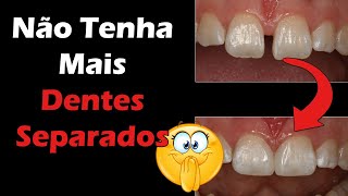 Como Fechar o Espaço Entre os Dentes da Frente  Tratamento Diastema  Aparelho Resina e Facetas [upl. by Aciretahs712]