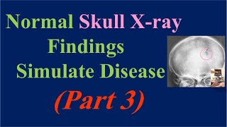 Normal Skull Xray Findings Simulate Disease part 3 Pacchionian Granulation amp Wormian bones [upl. by Findley378]