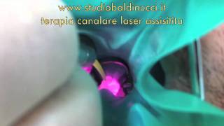 Terapia canalare laser assistitam4v [upl. by Nidnal191]