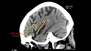 Introduction to Brain Surface Anatomy [upl. by Renny]