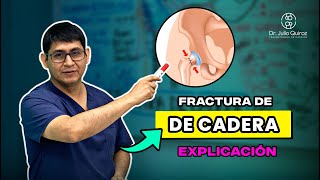 TIPOS DE FRACTURA DE CADERA  intracapsular vs extracapsular [upl. by Harpole922]