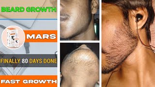 BEARD GROWTH  Finally 80 days complete  Fast beard growth from minoxidil ✨️ 3 months done ✔️ [upl. by Aisilef911]