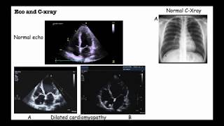 Dilated Cardiomyopathy Causes symptoms Diagnosis amp Treatment Bryte Medical Lectures [upl. by Ssilem]