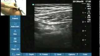 Ultrasound anatomy of the femoral nerve [upl. by Itteb]