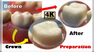 The Ultimate Crown Prep Tutorial Lower First Molar Made Easy [upl. by Vary]