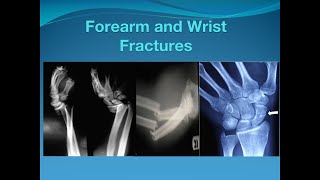 Forearm and Wrist fractures [upl. by Mace]