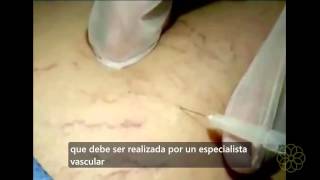 Escleroterapia Tratamiento efectivo para las varices y venas arañitas [upl. by Biebel540]