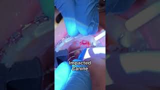 Exposed and Bond procedure  Impacted Canine  Video 6 Tooth Time Family Dentistry New Braunfels TX [upl. by Hyman]