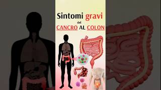 Sintomi gravi del cancro al colon [upl. by Mastic]