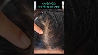 চুল পড়া বন্ধ হয়ে নতুন চুল গজাবেchul pora bondho korar upayHair regrowthHair fall control oil [upl. by Lacee243]