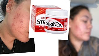 ONE MONTH USING STRIDEX PADS FOR MY ACNE [upl. by Aland]