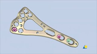 Radius Distal  Intraarticular Fracture Fixation Using VALCP Volar TwoColumn Distal Radius Plate [upl. by Kwapong]