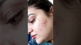 How I Cleared My Acne with Fix Derma Acne Control amp OilFree Moisturizer [upl. by Barthol]