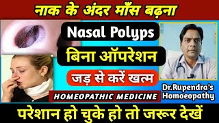 नाक के अंदर माँस बढ़ना। Nasal Polyps Treatment Without Surgery। Nasal Polyps Homeopathic Medicine। [upl. by Edi]