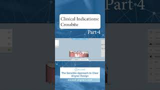 Clinical Indications Crossbite Part 4 [upl. by Idihc]