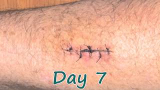 Time Lapse Recovery from Forearm Surgery [upl. by Paulita]