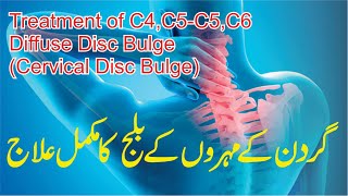 Treatment of C45C5C6 Diffuse Disc Bulge  Cervical Disc Bulge   Gardan K Muhron K Dard Ka Elaj [upl. by Etteve492]