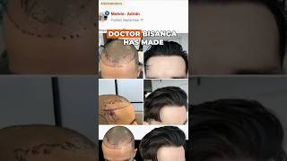 Life after a poor hair transplant shorts hairtransplant hairtransplantrepair bhrclinic [upl. by Senaj]