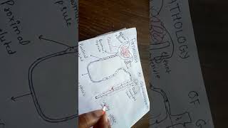 pathogenesis of glomerulonephritis NGMedicals [upl. by Blount]