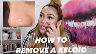 HOW I REMOVED MY NOSE PIERCING BUMP KELOID FAST [upl. by Dur]