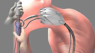 Thoracic Aortic Graft  Medical Animation by Watermark [upl. by Adolphus]