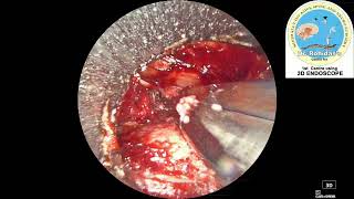 Rt L5S1 endo discectomy [upl. by Cailly]