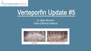 Verteporfin Update 5  Is it Working Whats Next Watch Until the End  Feller amp Bloxham NY [upl. by Correy]