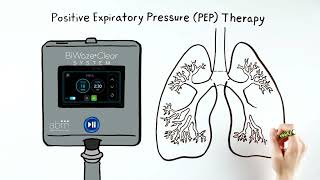 BiWaze® Clear Hospital Animation  Annas Story [upl. by Esinehs]