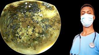 🔴cleaning of fungi affected ear full of it earearwax earwaxremovalearwaxcleaningasmr [upl. by Nosae]