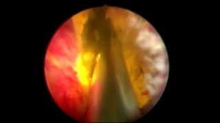 Greenlight XPS Laser Procedure [upl. by Ayhay893]