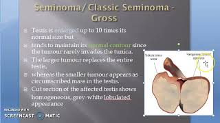 Pathology 711 c Seminoma Tumor Cancer Malignancy neoplasia neoplasm Germ cell Classic [upl. by Scotney]