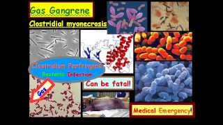 Gas Gangrene Overview [upl. by Enitsud]