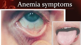 Anemia symptoms [upl. by Einegue779]