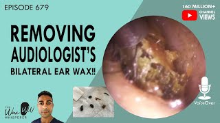 679  Removing Audiologists Bilateral Ear Wax [upl. by Mercedes599]