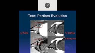 MRI of the Shoulder 2023 – Anterior Labral Tears Part 2 [upl. by Notwen668]