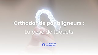 Orthodontie invisible par aligneurs  la pose de taquets [upl. by Terle]