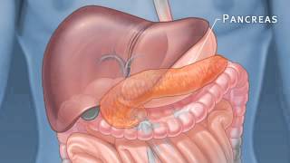 Pancreatic Auto Islet Transplantation with Total Pancreatectomy [upl. by Gayl484]