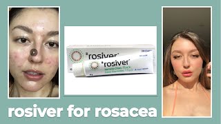 Rosiver Ivermectin Cream For Rosacea Review [upl. by Swain43]