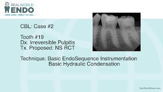 CBL 2 Basic Molar Root Canal Therapy 19 by RealWorldEndo [upl. by Ardnaxila]