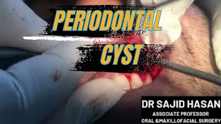 ENUCLEATION OF LATERAL PERIODONTAL CYST [upl. by Holsworth356]