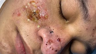 Big Cystic Acne Blackheads Extraction Blackheads amp Milia Whiteheads Removal Pimple Popping  1428 [upl. by Tibbs235]