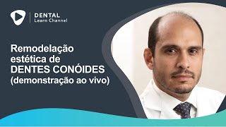 Remodelação estética de dentes conóides demonstração ao vivo [upl. by Nyvrem820]