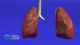 What Do I Need to Know About Lung Resection [upl. by Kristine]