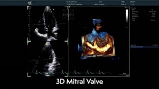 〖Echocardiography〗 The Mitral Valve in 3D  TTE 🫀 [upl. by Eintroc299]