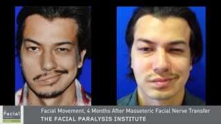 Masseter To Facial Nerve Surgery  Facial Paralysis Expert Dr Azizzadeh [upl. by Bray]