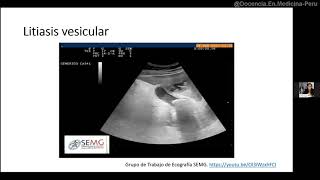 Colecistitis aguda criterios de Tokio y ecografía [upl. by Asiulairam145]