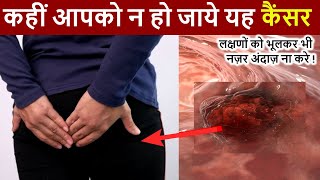 पेट में Colon Cancer के शुरुआती लक्षण  Early Warning Signs Of Colon Cancer You Should Not Ignore [upl. by Kehr]