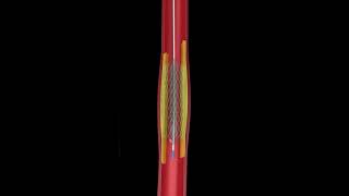 Angioplasty amp Heart Blockage Explained in Animation [upl. by Adriana]