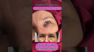 Qovoq olish  қовоқ олиш  blefaroplastika Doctor ODILJON 998974347791 TOSHKENT VA JIZZAXDA rek [upl. by Ahsenrad]